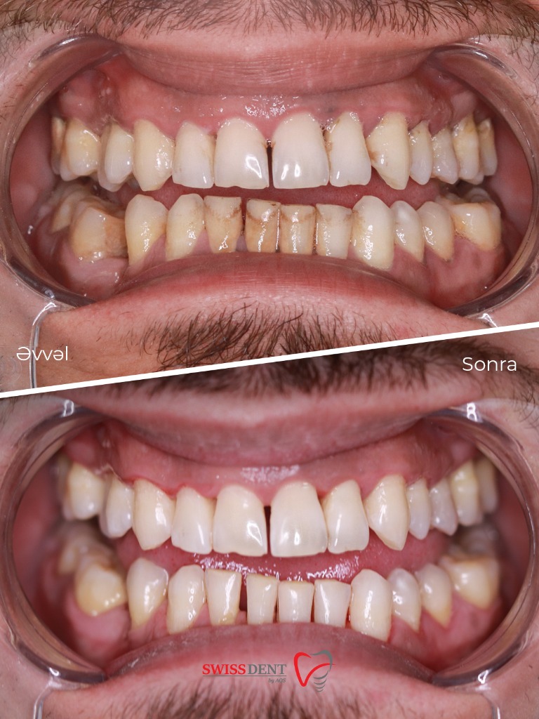 Diastema Qapanması və Estetik Bərpa Əvvəl və Sonra