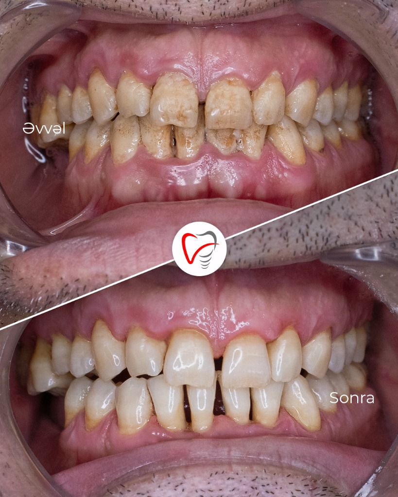 Periodontoloji Müalicə Əvvəl və Sonra